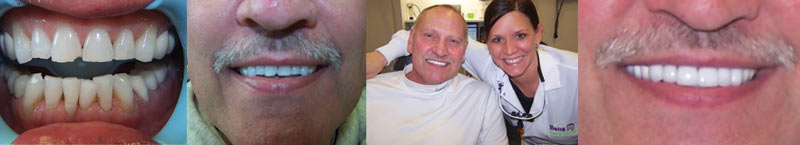 Cosmetic Smile Makeover